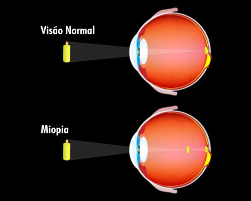 Comparação Miopia
